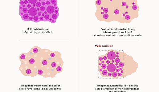 Illustrationen visar hur tumörceller kan vara fördelade i ett preparat och hur en microdissektion ser ut.
