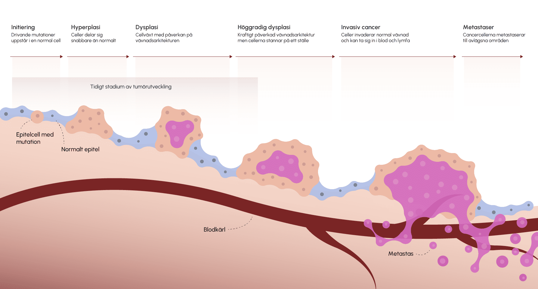 Illustration som visar den gradvisa utvecklingen av malignitet. Illustration som visar den gradvisa utvecklingen av malignitet.